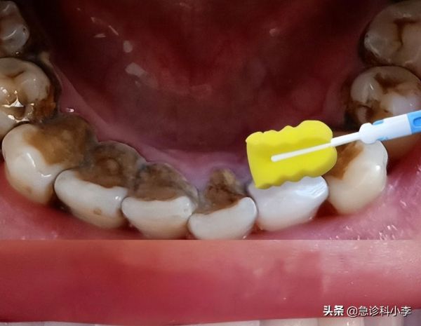 牙缝里的牙结石怎么清理，有3个办法可以选择哦