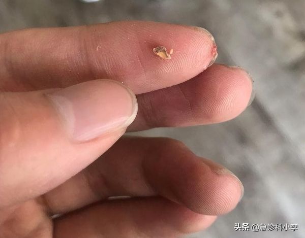 牙缝里的牙结石怎么清理，有3个办法可以选择哦