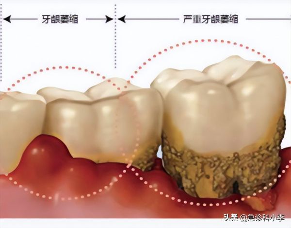 牙缝里的牙结石怎么清理，有3个办法可以选择哦